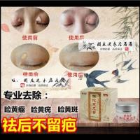睑瘤草本乳膏圆睑瘤膏去除睑瘤康膏睑疣斑膏专用眼皮脸