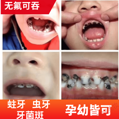 虫牙填补防蛀牙修复牙洞龋齿牙膏非孕妇儿童清理黑斑虫牙牙疼牙痛牙粉ifacial
