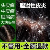 治头部脂溢性皮炎头皮癣头癣外用止痒药膏去屑洗发水
