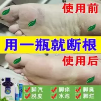 皮肤液美孚浮特皮肤教美孚特液足脚宝粉成人齐峰同宗堂足宝套装
