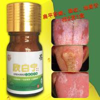 口腔扁平苔藓反复网状白纹斑口腔苔藓舌炎地图舌上火舌裂痛护理散