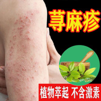 荨麻 疹断跟专用治i疗慢性寻荨 麻疹过敏止痒断根 风团中 病胆碱能性儿童膏