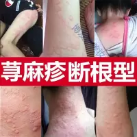 寻麻疹皮肤专用专用急慢性寻荨麻疹外用去根风团过敏皮肤瘙痒止痒丸中膏