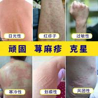 寻麻疹皮肤专用专用治急慢性寻荨麻疹外用去根风团过敏皮肤瘙痒止痒丸中膏(涅肤(Nie Fu))神芝乳膏