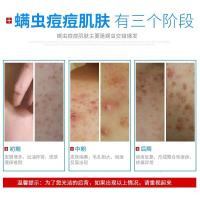 背上长痘痘后背部痘印前胸口背部背上身上背后长痘痘粉刺虫皂沐浴露