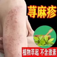 荨麻诊疹断跟专用治i疗慢性寻荨 寻麻疹过敏止痒断根 风团中 病胆碱能性儿童膏