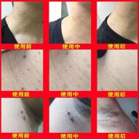 颈部腋下肉粒去除点猴子疙瘩颈部腋下脖子小肉粒丝状尤刺猴肉瘤痣 膏