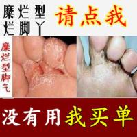 治脚气软膏脚痒水泡烂脚丫脚趾糜烂脚趾发白潮湿特效糜烂性脚气
