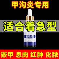 [优选好货]甲沟炎专用神器指甲去肉芽嵌甲红肿疼痛矫正器软化脱甲