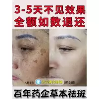 [优选好货]同仁堂祛斑霜淡斑色斑去黑色素去斑祛褐斑雀斑男女神器