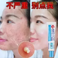【优选好货】研春堂祛痘膏去痘坑痘印痘疤抖音同款祛青春痘学生亮肤淡印膏