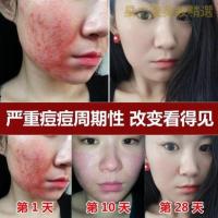 [优选好货]致顺棠堂舒根清安平去痘印除膏凝胶西林祛痘膏疤慕肤国正品