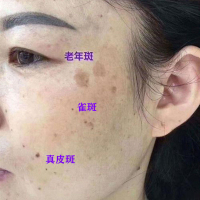 粉嫩公主美白祛斑霜(无效包退)黄褐斑雀斑遗传斑晒斑蝴蝶斑淡化黑斑老年斑精华霜膏产品男士女士护肤面霜