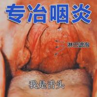 喉咙有痰异物感咽喉爽喷剂蜂胶止扁桃体发炎肿痛嗓子干痒咳嗽神器 [一瓶试用装] 咽喉不适
