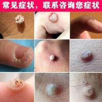 治瘊子鸡眼跖疣寻常疣去刺猴子肉刺鸡眼膏病毒疣趾疣鸡疣灵