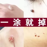去脖子小肉粒赘皮扁平尤祛疣瘊丝状尤腋下小猴子膏