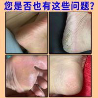 [一涂就嫩]去脚底脚后跟死皮角质干裂脱皮补水嫩白足部护理神器 皮专用一盒装