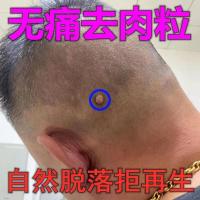 [专攻去瘊子]去除脖子小肉粒赘皮扁平尤祛疣瘊丝状尤腋下小猴子 一盒装