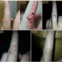 周氏去猴灵膏 跖疣 刺猴 鸡眼膏 老茧 脚垫 寻常尤疣 丝状疣 瘊子