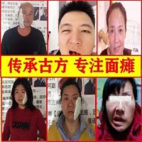 面瘫面瘫贴牵正膏面瘫后遗症面瘫膏吊线风嘴歪眼斜痉挛韩氏面瘫贴