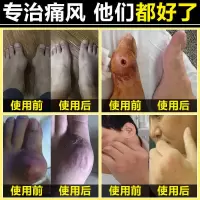 痛风克星贴专用膏贴手指大脚趾变形疼痛结晶降尿酸消肿痛风关节贴