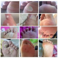 去除鸡尤克膏跖疣鸡尤泰鸡尤康茧子脚垫胼胝肉刺瘊子鸡眼膏贴