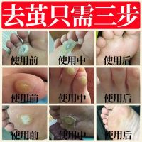 [不用挖无痛]鸡眼膏贴鸡尤清液祛除手脚鸡眼去猴子鸡茧死皮脚垫 関炷扂舗/沋姺潑貨 鸡眼/抑菌露1盒[5毫升不够用]