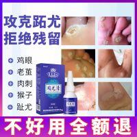 鸡尤清去鸡眼除猴子肉粒疙瘩脚趾跖疣脚底手部足部专用去老茧神器 鸡尤清【1盒装】