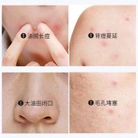 除螨皂神器除螨虫香皂全身祛痘神器青春痘学生去痘痘产品身上美白