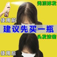 体验装[1瓶] [适合急性子]快速生发液脂溢性增发密发育发液秃顶脱发产后防脱