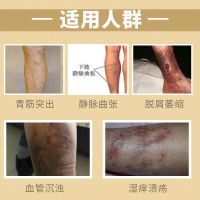 静脉曲张膏蚯蚓腿青筋凸起静脉曲张腿部青筋肿胀凸起红血丝修复霜