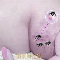 体验装[轻度痘痘痘印]一支装 南京同仁堂祛痘膏去痘印修复凹洞痘坑神器学生除青春痘男女芦荟胶