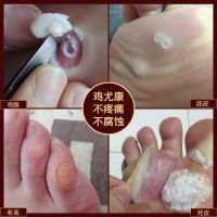 鸡尤康鸡眼膏贴去脚趾疣肉刺瘊子脚底老茧手足部死皮去疣灵鸡尤净