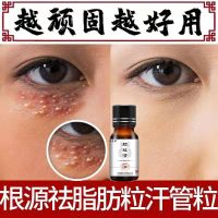 1盒(送专业棉签) 颗粒清去脂肪粒汗管粒神器去除脸部眼部油脂粒祛除膏眼霜克星女男