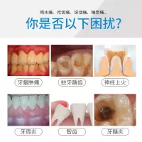 快速止牙痛牙疼虫牙蛀牙牙洞牙龈肿痛牙神经痛上火牙周炎消炎止痛