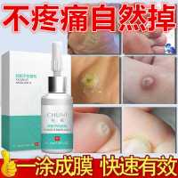 去跖疣鸡眼瘊子刺猴净去除足部脚底手部专用神器肉刺疣灵 默认
