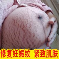 祛妊娠纹产后修复橄榄油护理萎缩纹紧致消除生长纹孕期预防精油