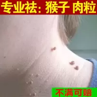 去除脖子小肉粒颈部赘皮赘草温和不留疤祛丝状尤腋下小猴子 1盒装