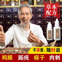 去除鸡眼跖疣寻常疣瘊子去刺猴子肉刺鸡眼膏病毒疣拓疣去疣灵特效