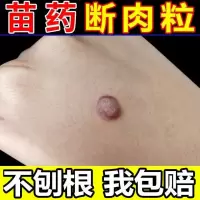 去除脖子小肉粒颈部赘皮赘草温和不留疤 祛丝状尤腋下小猴子