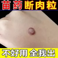 去除脖子小肉粒颈部赘皮赘草温和不留疤祛丝状尤腋下小猴子