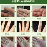 治瘊子跖疣寻常疣祛鸡眼去刺猴子肉刺鸡眼膏病毒疣拓疣去疣灵特效 疣瘊膏[专治鸡眼瘊子跖疣]轻度