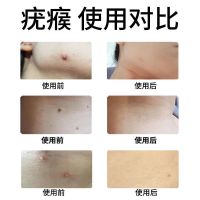 去除脖子小肉粒颈部赘皮 草本温和不留疤 祛丝状疣腋下小猴子抑菌 一瓶[试用装]10ML