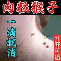 去除脖子小肉粒颈部赘皮赘草温和不留疤 祛丝状尤腋下小猴子