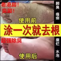 金泰康脚气喷剂脚气软膏脚痒蜕皮除脚臭汗脚烂脚丫膏脚气套装克星 软膏[一支]