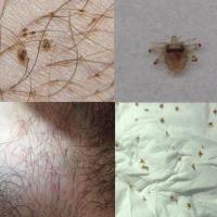 3号虫立净章阴虱男女士私处灵一扫光赣除虱喷剂子净虱泽绿达