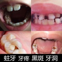 防蛀牙牙膏龋齿修复虫牙洞清理黑斑儿童牙菌斑洗牙粉去祛除黑神器