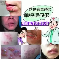 嘴巴疹嘴角嘴唇疱唇炎上火起水泡糜烂炎膏唇干裂起皮脱皮专用乳膏