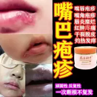 嘴巴嘴嘴唇疹唇炎上火起水泡糜烂炎唇膏疱干裂起角皮脱皮专用乳膏