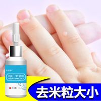 一年以内疣专用一瓶装 鸡眼膏贴去瘊子肉粒疙瘩去脖子肉粒扁平疣腋下小猴子鸡眼刺猴跖疣